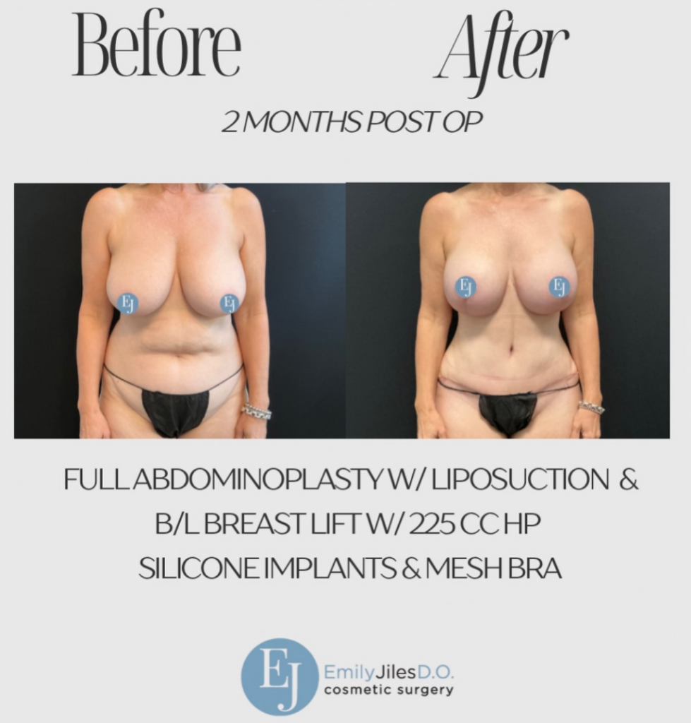 Our lovely patient is just 2 months post-op from her full Mommy Makeover and is healing beautifully. While she’s already enjoying an incredible transformation, her results will continue to refine as swelling subsides and healing progresses over the coming months. *Abdominoplasty incision lines continue to mature over time and with Dr. Jiles’ post op care regimen they typically fade into barely visible thin white lines as healing progresses*