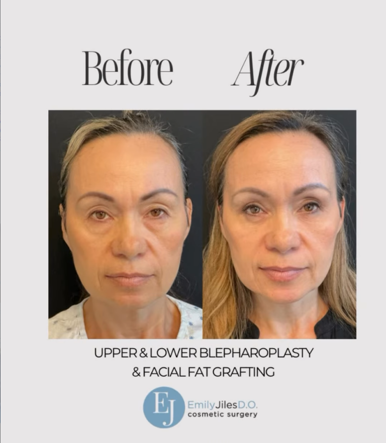 upper and lower bleph before and after photos. Also fat grafting
